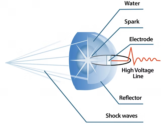 Diagram illustrating how a shockwave therapy device works